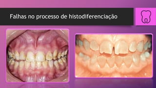 Falhas no processo de histodiferenciação
 