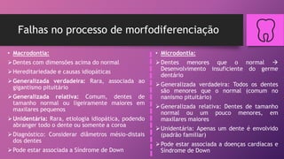 Falhas no processo de morfodiferenciação
• Macrodontia:
Dentes com dimensões acima do normal
Hereditariedade e causas idiopáticas
Generalizada verdadeira: Rara, associada ao
gigantismo pituitário
Generalizada relativa: Comum, dentes de
tamanho normal ou ligeiramente maiores em
maxilares pequenos
Unidentária: Rara, etiologia idiopática, podendo
abranger todo o dente ou somente a coroa
Diagnóstico: Considerar diâmetros mésio-distais
dos dentes
Pode estar associada a Síndrome de Down
• Microdontia:
Dentes menores que o normal 
Desenvolvimento insuficiente do germe
dentário
Generalizada verdadeira: Todos os dentes
são menores que o normal (comum no
nanismo pituitário)
Generalizada relativa: Dentes de tamanho
normal ou um pouco menores, em
maxilares maiores
Unidentária: Apenas um dente é envolvido
(padrão familiar)
Pode estar associada a doenças cardíacas e
Síndrome de Down
 
