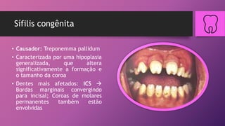 Sífilis congênita
• Causador: Treponemma pallidum
• Caracterizada por uma hipoplasia
generalizada, que altera
significativamente a formação e
o tamanho da coroa
• Dentes mais afetados: ICS 
Bordas marginais convergindo
para incisal; Coroas de molares
permanentes também estão
envolvidas
 