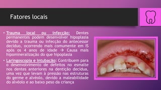 Fatores locais
• Trauma local ou infecção: Dentes
permanentes podem desenvolver hipoplasia
devido a trauma ou infecção do antecessor
decíduo, ocorrendo mais comumente em IS
após os 4 anos de idade  Causa mais
hipomineralização do que hipoplasia
• Laringoscopia e intubação: Contribuem para
o desenvolvimento de defeitos no esmalte
nos dentes anteriores na dentição decídua,
uma vez que levam à pressão nas estruturas
do germe e alvéolo, devido a maleabilidade
do alvéolo e ao baixo peso da criança
 