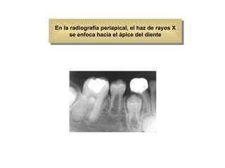 En la radiografía periapical, el haz de rayos X se enfoca hacia el ápice del diente 