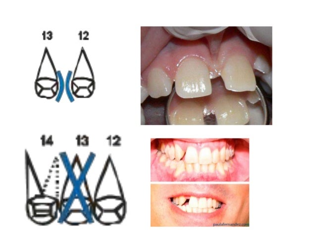 Resultado de imagen para odontograma movilidad dentaria 
