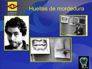 Huellas de mordedura G.B.P 