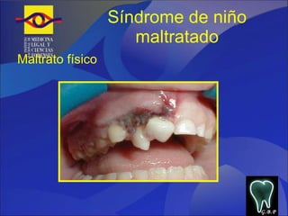 Síndrome de niño maltratado Maltrato físico G.B.P 
