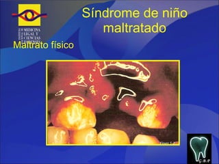 Síndrome de niño maltratado Maltrato físico G.B.P 
