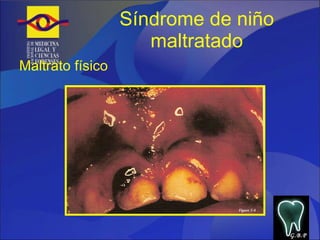Síndrome de niño maltratado Maltrato físico G.B.P 