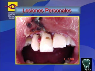 G.B.P Lesiones Personales   