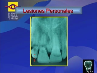 G.B.P Lesiones Personales   