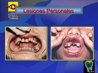 G.B.P Lesiones Personales   