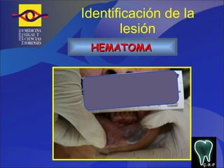 Identificación de la lesión HEMATOMA   G.B.P 
