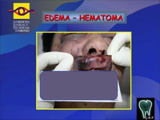 EDEMA – HEMATOMA   G.B.P 