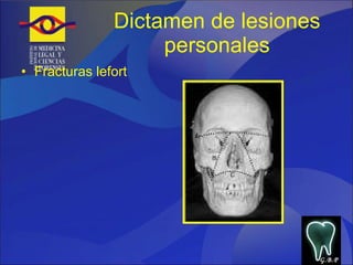 Dictamen de lesiones personales Fracturas lefort G.B.P 