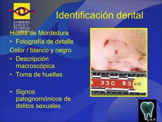 Identificación dental Huella de Mordedura Fotografía de detalle Color / blanco y negro Descripción macroscópica Toma de huellas Signos patognomónicos de delitos sexuales G.B.P 