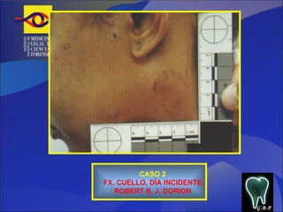CASO 2 FX. CUELLO, DÍA INCIDENTE ROBERT B. J. DORION G.B.P 
