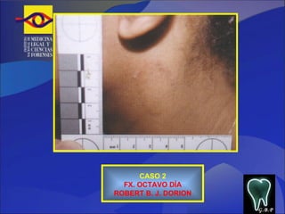 CASO 2 FX. OCTAVO DÍA ROBERT B. J. DORION G.B.P 
