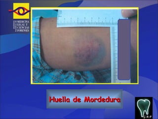 Huella de Mordedura G.B.P 