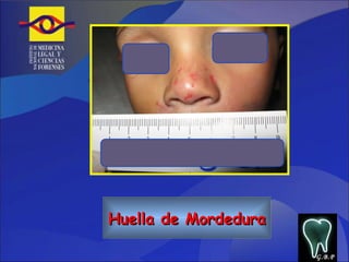 Huella de Mordedura G.B.P 