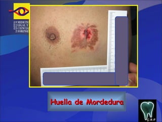 Huella de Mordedura G.B.P 