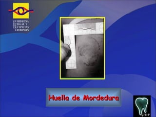 Huella de Mordedura G.B.P 