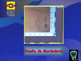 Huella de Mordedura G.B.P 