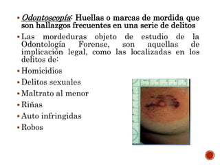  Odontoscopía: Huellas o marcas de mordida que
son hallazgos frecuentes en una serie de delitos
 Las mordeduras objeto de estudio de la
Odontología Forense, son aquellas de
implicación legal, como las localizadas en los
delitos de:
 Homicidios
 Delitos sexuales
 Maltrato al menor
 Riñas
 Auto infringidas
 Robos
 