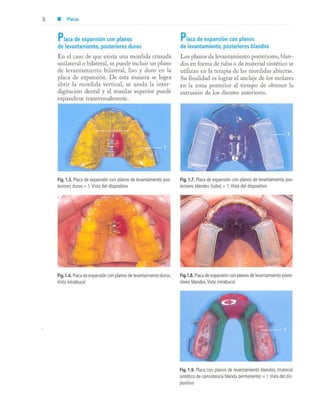 aparatología en ortopedia funcional.