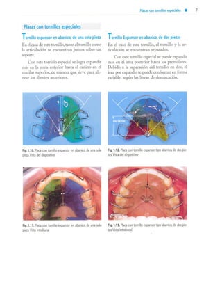 aparatología en ortopedia funcional.