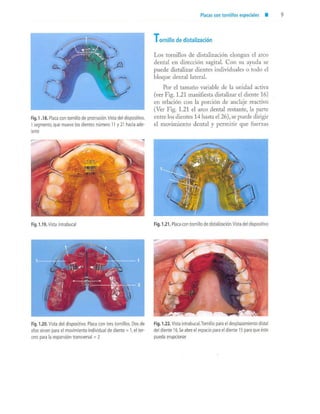 aparatología en ortopedia funcional.