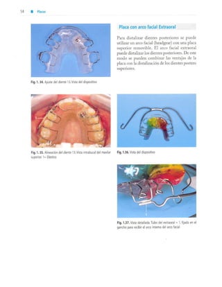 aparatología en ortopedia funcional.