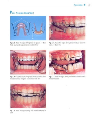 aparatología en ortopedia funcional.