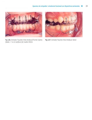 aparatología en ortopedia funcional.