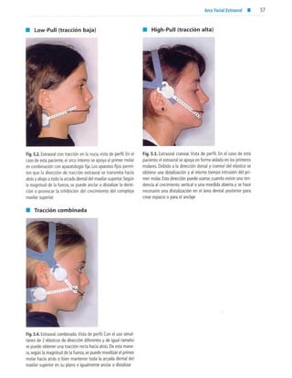 aparatología en ortopedia funcional.