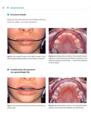 aparatología en ortopedia funcional.
