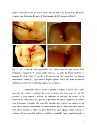 espessa e iniciação de uma nova lesão cariosa ativa na entrada das fissuras (Fig. 2D). Este é
o mesmo local de iniciação das lesões de fissura quando não há “selamento biológico”.




     A                                               B




     C                                               D

Fig. 2. face oclusal de molar permanente com fissura preenchida por cálculo dental
(“selamento biológico”). A, cálculo sendo removido. B, corte da fissura mostrando a
presença do cálculo (seta). C, ocorrência de placa espessa (seta) sobre área com fissuras
com cálculo (“seladas”). D, após remoção da placa espessa, a lesão ativa (seta) se inicia na
entrada da fissura, mesmo local de início quando não há cálculo.


               Continuando com as alterações durante a erupção, à medida que o dente
erupciona, ele começa a participar das forças mecânicas intra-orais, que, por sua vez,
removem a placa espessa e realizam um polimento da superfície do esmalte. Só há
condições de formar placa fina, que não é patológica. Os cristais superficiais do esmalte
mais frouxamente arranjados são removidos, expondo áreas internas, que podem ou não
estar com os espaços intercristalinos em menor tamanho. Esta é a lesão inativa (em áreas de
forte atrição mecânica e abaixo de placa fina). Caso estes espaços estejam menores, o
resultado será uma superfície polida, com brilho e translúcida. Caso a desmineralização já



                                                                                            6
 