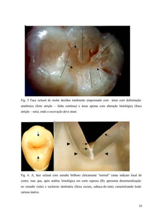 Fig. 5 Face oclusal de molar decíduo totalmente erupcionado com áreas com deformação
anatômica (forte atrição – linha contínua) e áreas apenas com alteração histológica (fraca
atrição – seta), onde a escovação deve atuar.




Fig. 6. A, face oclusal com esmalte brilhoso clnicamente “normal” (setas indicam local do
corte), mas que, após análise histológica em corte espesso (B), apresenta desmineralização
no esmalte (seta) e esclerose dentinária (faixa escura, cabeça-de-seta), caracterizando lesão
cariosa inativa.



                                                                                           10
 