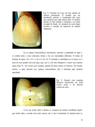 Fig. 8. Variação de cores da face palatal de
                                         incisivo permanente. O esmalte, por ser
                                         translúcido, permite a visualização das cores
                                         das estruturas que estão abaixo dele. As bordas
                                         incisais só têm esmalte e mostram a cor preta
                                         do papel de fundo. As variações de cores beges
                                         revelam a variação da espessura de dentina
                                         subjacente.




              Se os espaços intercristalinos aumentarem, aumenta a quantidade de água e
ar contida neles e esses elementos freiam a luz em intensidades diferentes. O índice de
refração da água é de 1,33 e o do ar é de 1,0. O resultado é semelhante ao se tentar ver a
areia do mar quando está com água suja, isto é, a luz não ultrapassa e vemos uma mancha
opaca (Fig. 9). Isto ocorre, por exemplo, quando há lesão cariosa ou fluorose. No esmalte
maturo, a água presente nos espaços intercristalinos não é suficiente para produzir
opacidade.



                                                          Fig. 9. Esmalte com manchas
                                                          bbrancas decorrentes de lesão
                                                          cariosa (seta) e de fluorose
                                                          (cabeça de seta).




              A luz que incide sobre a dentina se comporta de maneira semelhante àquela
que incide sobre o esmalte com lesão cariosa, isto é, não é translúcida. O material entre os


                                                                                           15
 