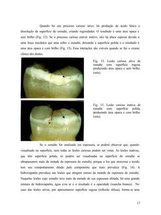 Quando há um processo carioso ativo, há produção de ácido lático e
dissolução da superfície do esmalte, criando rugosidades. O resultado é uma área opaca e
sem brilho (Fig. 12). Se o processo carioso estiver inativo, não há placa espessa devido a
uma força mecânica que atua sobre o esmalte, deixando a superfície polida e o resultado é
uma área opaca e com brilho (Fig. 13). Essa interações são visíveis quando se faz o exame
clínico dos dentes.

                                                        Fig. 12. Lesão cariosa ativa de
                                                        esmalte com superfície rugosa,
                                                        produzindo área opaca e sem brilho
                                                        (seta).




                                                        Fig. 13. Lesão cariosa inativa de
                                                        esmalte com superfície polida,
                                                        produzindo área opaca e com brilho
                                                        (seta).




                Se o esmalte for analisado em espessura, se poderá observar que, quando
visualisado na superfície, nem todas as lesões cariosas podem ser vistas. As lesões inativas,
que têm superfície polida, só podem ser visualisadas na superfície do esmalte se
ultrapassarem mais da metade da espessura do esmalte, porque a luz que atravessa o tecido
tem seu comportamento ditado pelo componente que mais prevalece (Fig. 14). A
hidroxiapatita prevalece nas lesões que atingem menso da metade da espessura do esmalte.
Naquelas lesões cujo esmalte teve mais da metade de sua espessura afetada, há uma grande
mistura de hidroxiapatita, água e/ou ar e o resultado é a opacidade (mancha branca). No
caso das lesões ativas, por apresentarem superfície rugosa (reflexão difusa), forma-se uma



                                                                                           17
 