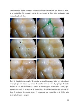quando mastiga, deglute e escova, realizando polimento da superfície que devolve o brilho
e a translucidez. Na verdade, trata-se de um evento de física ótica confundido com
remineralização pelo flúor.




Fig. 16. Seqüência das reações do esmalte ao condicionamento ácido e à subseqüente
escovação por um minuto. A, aspecto do esmalte antes do ácido. B, aplicação do ácido
fosfórico a 37% por um minuto. C, aspecto do esmalte (opaco e sem brilho – setas) após
aplicação do ácido. D, recuperação da translucidez e do brilho do esmalte pela aplicação de
água E, aplicação da escova dental. F, recuperação da translucidez e do brilho após
escovação, lavagem e secagem.


                                                                                         19
 