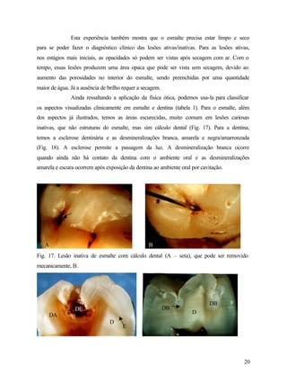 Esta experiência também mostra que o esmalte precisa estar limpo e seco
para se poder fazer o diagnóstico clínico das lesões ativas/inativas. Para as lesões ativas,
nos estágios mais iniciais, as opacidades só podem ser vistas após secagem com ar. Com o
tempo, essas lesões produzem uma área opaca que pode ser vista sem secagem, devido ao
aumento das porosidades no interior do esmalte, sendo preenchidas por uma quantidade
maior de água. Já a ausência de brilho requer a secagem.
               Ainda ressaltando a aplicação da física ótica, podemos usa-la para classificar
os aspectos visualizadas clinicamente em esmalte e dentina (tabela 1). Para o esmalte, além
dos aspectos já ilustrados, temos as áreas escurecidas, muito comum em lesões cariosas
inativas, que não estruturas do esmalte, mas sim cálculo dental (Fig. 17). Para a dentina,
temos a esclerose dentinária e as desmineralizações branca, amarela e negra/amarronzada
(Fig. 18). A esclerose permite a passagem da luz. A desmineralização branca ocorre
quando ainda não há contato da dentina com o ambiente oral e as desmineralizações
amarela e escura ocorrem após exposição da dentina ao ambiente oral por cavitação.




   A                                              B
Fig. 17. Lesão inativa de esmalte com cálculo dental (A – seta), que pode ser removido
mecanicamente, B.




                                                                            DB
                 DE                                        DB
                                                                    D
       DA
                                 D
                                      E




                                                                                           20
 