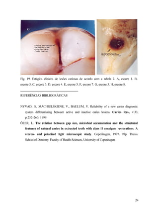 G                                                             H




Fig. 19. Estágios clínicos de lesões cariosas de acordo com a tabela 2. A, escore 1. B,
escore 5. C, escore 3. D, escore 4. E, escore 5. F, escore 7. G, escore 5. H, escore 8.


REFERÊNCIAS BIBLIOGRÁFICAS


NYVAD, B., MACHIULSKIENE, V., BAELUM, V. Reliability of a new caries diagnostic
   system differentiating between active and inactive caries lesions. Caries Res., v.33,
   p.252-260, 1999.
ÖZER, L. The relation between gap size, microbial accumulation and the structural
   features of natural caries in extracted teeth with class II amalgam restorations. A
   stereo- and polarized light microscopic study. Copenhagen, 1997. 98p. Thesis.
   School of Dentistry, Faculty of Health Sciences, University of Copenhagen.




                                                                                          24
 