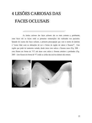 4 LESÕES CARIOSAS DAS
    FACES OCLUSAIS


              As lesões cariosas das faces oclusais são as mais comuns e, geralmente,
estas faces são os locais onde as primeiras restaurações são realizadas nos pacientes.
Quando do exame das faces oclusais, a primeira preocupação que vem à mente do dentista
é “como lidar com as alterações de cor e forma da região de sulcos e fissuras?”. Esta
região que pode ter anatomia variada, desde áreas com sulcos e fissuras rasos (Fig. 20B –
com fissura em forma de “V”) até áreas com sulcos e fissuras estreitos e profundos (Fig.
20D – com fissura em forma de “I”) onde as cerdas das escovas dentais não entram.




   A                            B




                                                                                      25
 