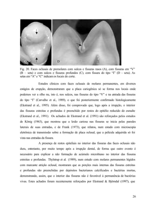 C                             D

Fig. 20. Faces oclusais de premolares com sulcos e fissuras rasos (A), com fissuras em “V”
(B – seta) e com sulcos e fissuras profundos (C), com fissura do tipo “I” (D – seta). As
setas em “A” e “C” indicam os locais do corte.

                Estudos clínicos com faces oclusais de molares permanentes, em diversos
estágios de erupção, demonstraram que a placa cariogênica só se forma nos locais onde
podemos ver a olho nu, isto é, nos sulcos, nas fissuras do tipo “V” e na entrada das fissuras
do tipo “I” (Carvalho et al., 1989), o que foi posteriormente confirmado histologicamente
(Ekstrand et al., 1995). Além disso, foi comprovado que, logo após a irrupção, o interior
das fissuras estreitas e profundas é preenchido por restos do epitélio reduzido do esmalte
(Ekstrand et al., 1991). Os achados de Ekstrand et al. (1991) são reforçados pelos estudos
de König (1963), que mostrou que a lesão cariosa nas fissuras se inicia pelas paredes
laterais de suas entradas, e de Frank (1973), que relatou, num estudo com microscopia
eletrônica de transmissão sobre a formação de placa oclusal, que a película adquirida só foi
vista nas entradas da fissura.
                A presença de restos epiteliais no interior das fissuras das faces oclusais não
dura, entretanto, por muito tempo após a irrupção dental, de forma que outro evento é
necessário para explicar a não formação de acúmulo microbiano no interior das fissuras
estreitas e profundas. Thylstrup et al. (1989), num estudo com molares permanentes hígidos
com marcante atrição oclusal, mostraram que as porções mais internas das fissuras estreitas
e profundas são preenchidas por depósitos bacterianos calcificados e bactérias mortas,
demonstrando, assim, que o interior das fissuras não é favorável à permanência de bactérias
vivas. Estes achados foram recentemente reforçados por Ekstrand & Björndal (1997), que



                                                                                            26
 