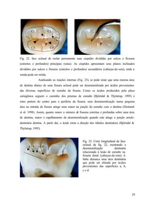 C1              C2




         C3               C4


Fig. 22. face oclusal de molar permanente suas cúspides divididas por sulcos e fissuras
(estreitos e profundos) principais (setas). As cúspides apresentam seus planos inclinados
divididos por sulcos e fissuras (estreitos e profundos) secundários (cabeças-de-seta), onde a
sonda pode ser retida.
               Analisando as reações internas (Fig. 23), se pode notar que uma mesma área
de dentina abaixo de uma fissura oclusal pode ser desmineralizada por ácidos provenientes
das diversas superfícies de esmalte da fissura. Como os ácidos produzidos pela placa
cariogênica seguem o caminho dos prismas de esmalte (Björndal & Thylstrup, 1995) e
estes partem do centro para a periferia da fissura, uma desmineralização numa pequena
área na entrada da fissura atinge uma maior na junção do esmalte com a dentina (Ekstrand
et al. 1998). Assim, quanto maior o número de fissuras estreitas e profundas sobre uma área
de dentina, maior o espalhamento da desmineralização quando esta atinge a junção amelo-
dentinária dentina. A partir daí, o ácido toma a direção dos túbulos dentinários (Björndal &
Thylstrup, 1995).



                                                   Fig. 23. Corte longitudinal da face
                                                   oclusal da fig. 22, mostrando a
       a b     c d
                                                   desmineralização          dentinária
                                                   relacionada à lesão de esmalte na
                                                   fosseta distal (cabeças-de-seta). A
                                                   linha demarca uma área dentinária
                                                   que pode ser afetada por ácidos
                                                   provenientes das superfícies a, b,
                                                   c e d.




                                                                                          29
 