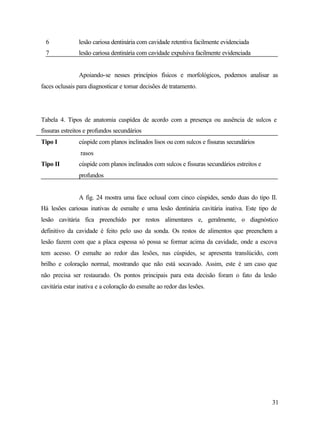 6            lesão cariosa dentinária com cavidade retentiva facilmente evidenciada
  7            lesão cariosa dentinária com cavidade expulsiva facilmente evidenciada


               Apoiando-se nesses princípios físicos e morfológicos, podemos analisar as
faces oclusais para diagnosticar e tomar decisões de tratamento.




Tabela 4. Tipos de anatomia cuspídea de acordo com a presença ou ausência de sulcos e
fissuras estreitos e profundos secundários
Tipo I         cúspide com planos inclinados lisos ou com sulcos e fissuras secundários
                rasos
Tipo II        cúspide com planos inclinados com sulcos e fissuras secundários estreitos e
               profundos


               A fig. 24 mostra uma face oclusal com cinco cúspides, sendo duas do tipo II.
Há lesões cariosas inativas de esmalte e uma lesão dentinária cavitária inativa. Este tipo de
lesão cavitária fica preenchido por restos alimentares e, geralmente, o diagnóstico
definitivo da cavidade é feito pelo uso da sonda. Os restos de alimentos que preenchem a
lesão fazem com que a placa espessa só possa se formar acima da cavidade, onde a escova
tem acesso. O esmalte ao redor das lesões, nas cúspides, se apresenta translúcido, com
brilho e coloração normal, mostrando que não está socavado. Assim, este é um caso que
não precisa ser restaurado. Os pontos principais para esta decisão foram o fato da lesão
cavitária estar inativa e a coloração do esmalte ao redor das lesões.




                                                                                             31
 
