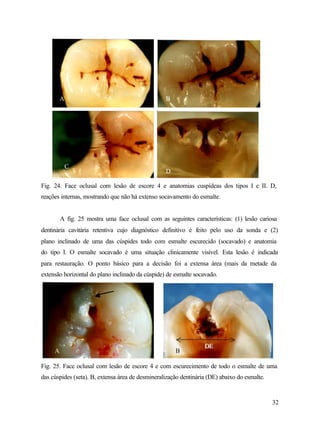 A                                        B




             C
                                                  D

Fig. 24. Face oclusal com lesão de escore 4 e anatomias cuspídeas dos tipos I e II. D,
reações internas, mostrando que não há extenso socavamento do esmalte.


         A fig. 25 mostra uma face oclusal com as seguintes características: (1) lesão cariosa
dentinária cavitária retentiva cujo diagnóstico definitivo é feito pelo uso da sonda e (2)
plano inclinado de uma das cúspides todo com esmalte escurecido (socavado) e anatomia
do tipo I. O esmalte socavado é uma situação clinicamente visível. Esta lesão é indicada
para restauração. O ponto básico para a decisão foi a extensa área (mais da metade da
extensão horizontal do plano inclinado da cúspide) de esmalte socavado.




                                                                  DE
     A                                                B

Fig. 25. Face oclusal com lesão de escore 4 e com escurecimento de todo o esmalte de uma
das cúspides (seta). B, extensa área de desmineralização dentinária (DE) abaixo do esmalte.


                                                                                              32
 