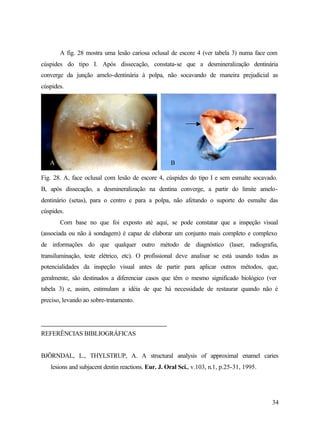 A fig. 28 mostra uma lesão cariosa oclusal de escore 4 (ver tabela 3) numa face com
cúspides do tipo I. Após dissecação, constata-se que a desmineralização dentinária
converge da junção amelo-dentinária à polpa, não socavando de maneira prejudicial as
cúspides.




   A                                                B

Fig. 28. A, face oclusal com lesão de escore 4, cúspides do tipo I e sem esmalte socavado.
B, após dissecação, a desmineralização na dentina converge, a partir do limite amelo-
dentinário (setas), para o centro e para a polpa, não afetando o suporte do esmalte das
cúspides.
       Com base no que foi exposto até aqui, se pode constatar que a inspeção visual
(associada ou não à sondagem) é capaz de elaborar um conjunto mais completo e complexo
de informações do que qualquer outro método de diagnóstico (laser, radiografia,
transiluminação, teste elétrico, etc). O profissional deve analisar se está usando todas as
potencialidades da inspeção visual antes de partir para aplicar outros métodos, que,
geralmente, são destinados a diferenciar casos que têm o mesmo significado biológico (ver
tabela 3) e, assim, estimulam a idéia de que há necessidade de restaurar quando não é
preciso, levando ao sobre-tratamento.




REFERÊNCIAS BIBLIOGRÁFICAS


BJÖRNDAL, L., THYLSTRUP, A. A structural analysis of approximal enamel caries
   lesions and subjacent dentin reactions. Eur. J. Oral Sci., v.103, n.1, p.25-31, 1995.




                                                                                           34
 
