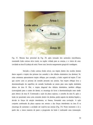 Área I
                 Lesão ativa


                                                    Área II



                                                    Área III

Fig. 31. Mesma face proximal da Fig. 29, após remoção dos acúmulos microbianos,
mostrando lesão cariosa ativa (seta), na região voltada para as ameias, e o início de uma
cavidade na área II (cabeça de seta). Neste caso, haveria sangramento gengival à sondagem.


               Iniciada a lesão cariosa (lesão ativa), seu trajeto dentro dos tecidos dentais
duros seguirá o trajeto dos prismas (no esmalte) e dos túbulos dentinários (na dentina). Se
estas estruturas apresentarem trajeto oblíquo, por exemplo, a lesão seguirá tal trajeto. É isto
que ocorre com os prismas do esmalte presente nas ameias. Seu trajeto oblíquo leva a
desmineralização da superfície do esmalte localizada na ameia para uma região dentinária
abaixo da área II. Daí, o trajeto diagonal dos túbulos dentinários, também oblíquo
(convergindo para o centro do dente), se encarrega de levar a desmineralização mais ainda
para abaixo da área II. Continuada a ação da placa espessa, o esmalte da área II, após a
lesão ter penetrado uma certa extensão dentro da dentina, perde suporte de dentina hígida e,
devido às forças de atrição interdentais, se fratura, formando uma cavitação. A ação
conjunta continuada da placa espessa nas ameias e das forças interdentais na área II se
encarrega de aumentar a cavidade até expô-la nas ameias (Fig. 33). Neste momento e só a
partir daí, a única maneira de parar a progressão da lesão é realizando uma restauração.



                                                                                             39
 