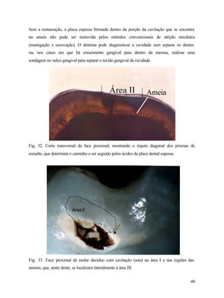 Sem a restauração, a placa espessa formada dentro da porção da cavitação que se encontra
na ameia não pode ser removida pelos métodos convencionais de atrição mecânica
(mastigação e escovação). O dentista pode diagnosticar a cavidade sem separar os dentes
ou, nos casos em que há crescimento gengival para dentro da mesma, realizar uma
sondagem no sulco gengival para separar o tecido gengival da cavidade.




                                                 Área II           Ameia




Fig. 32. Corte transversal da face proximal, mostrando o trajeto diagonal dos prismas de
esmalte, que determina o caminho a ser seguido pelos ácidos da placa dental espessa.




                          Área II




Fig. 33. Face proximal de molar decíduo com cavitação (seta) na área I e nas regiões das
ameias, que, neste dente, se localizam lateralmente à área III.


                                                                                       40
 