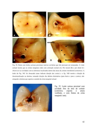 A                                                      B


                                                      esmalte




 C                                                          D                 dentina
                                                                                               polpa
Fig. 34. Dente com lesões cariosas proximais inativas cavitárias que não precisam ser restauradas. A visão
oclusal mostra que as cristas marginais estão com coloração normal (A). Por mesial (B) e por distal (C)
observa-se as cavidades com as aberturas localizadas dentro das áreas de contato interdental (contornos). A
lesão da Fig. 34C foi dissecada (setas indicam direção dos cortes) e a fig. 34D mostra a direção da
desmineralização na dentina, tomando direção dos túbulos dentinários (para baixo e para o centro), não
atingindo a dentina que suporta o esmalte da crista marginal oclusal.



                                                                 Fig. 35. Lesão cariosa proximal com
                                                                 cavidade fora da área de contato
                                                                 (contorno),       exposta à    ameia
                                                                 vestibular, e com fratura da crista
                                                                 marginal ( seta).




                                                                                                        42
 