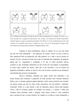 A                                                     B




 C                                                     D
Fig. 36. Relação entre tamanho e posição da área de contato interdental (AC) e a gengiva. No início, a AC é
como um ponto (A) e a gengiva fica logo abaixo. Com o tempo, a AC aumenta nos sentidos mésio-distal e
vestíbulo-lingual e a gengiva acompanha preenchendo a área III (B e C). O mau restabelecimento da AC, após
colocação de restauração, pode causar a situação em que a área III fica desprotegida da gengiva (D),
necessitando de uma higienização interdental. (Adaptado de Black, 1936).



                 Expostas as bases morfológicas, cabem as análises. Se no caso das lesões
que não são vistas clinicamente – não aparecem nas ameias-, tem-se: (1) que o local do
fator responsável pela sua progressão está onde podemos ver e onde a escova alcança (as
ameias); (2) que a presença de lesão ativa pode ser detectada pelo diagnóstico de gengivite
papilar (por ex.: sangramento à sondagem); e (3) que as lesões proximais inativas,
cavitárias ou não, localizadas estritamente na área II não tem vida própria, só progredindo
se houver placa espessa nas ameias, então não se faz necessário o uso de técnicas de
diagnóstico destinadas a analisar as áreas II e III a fim de tomar a decisão de que tratamento
será instituído (não invasivo ou restaurador).
                 Deve-se considerar, entretanto, que alguns autores têm justificado o uso
dessas técnicas para monitorar a progressão da lesão proximal entre consultas diferentes.
Porém, caso se encontre gengivite papilar adjacente à lesão cariosa proximal sem cavitação
nas ameias, mesmo que seja em várias visitas consecutivas, isso não justifica o tratamento
restaurador. Então, se é para decidir o tipo de tratamento, pode-se fazê-lo pela inspeção
visual a olho nu (restauro quando há cavitação nas ameias) e o mesmo é válido para
monitorar lesões proximais, sendo a inspeção visual menos invasiva e mais confortável
para o paciente do que os outros métodos. Na verdade, ao se indicar o exame radiográfico e


                                                                                                        43
 
